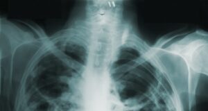 an x - ray image of a man's chest