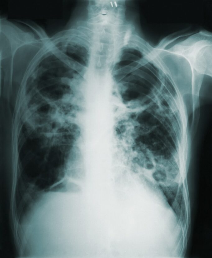 an x - ray image of a man's chest